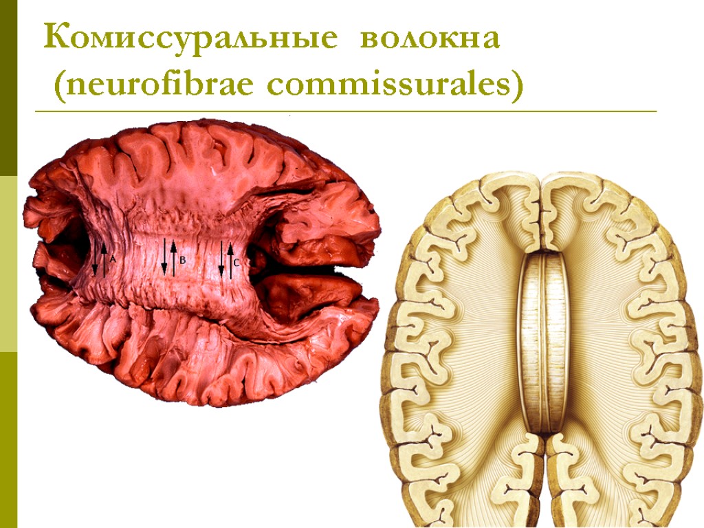 Комиссуральные волокна (neurofibrae commissurales)